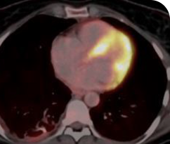 Metastatic NSCLC patient lung and bone scan 2 in primary and metastatic lesions Scan of lungs and bones in primary and metastatic lesions from a Metastatic NSCLC for a 30-year-old female patient