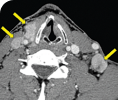 Metastatic papillary thyroid cancer male patient thyroid scan 1 in primary and metastatic lesions Scan of primary and metastatic lesions from a Metastatic disease for a 30-year-old male patient