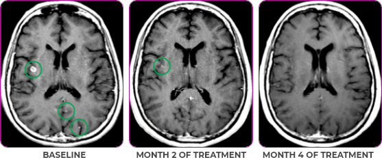 Brain scan in primary and metastatic lesions for a 76-year-old female patient  