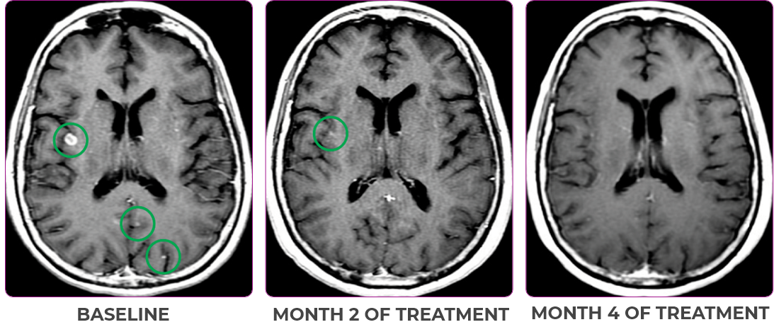 Brain scan in primary and metastatic lesions for a 76-year-old female patient 