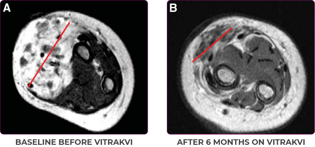 Tumor scan showing reduction in tumor in a 5-month-old with infantile fibrosarcoma  