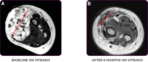 Tumor scan showing reduction in tumor in a 5-month-old with infantile fibrosarcoma  