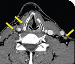 Metastatic papillary thyroid cancer male patient thyroid scan 1 in primary and metastatic lesions Scan of primary and metastatic lesions from a Metastatic disease for a 30-year-old male patient