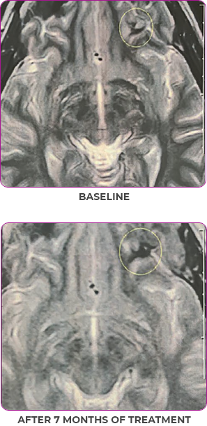 Female thyroid cancer patient brain scan in primary and metastatic lesions Female thyroid cancer patient brain in primary and metastatic lesions in a 7-month treatment duration