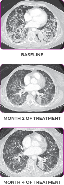 Lung metastases scan showing primary and metastatic lesions in a 76-year-old female patient Lung metastases scan in primary and metastatic lesions