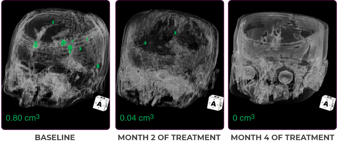 Brain metastases scan showing primary and metastatic lesions with measurements in green Brain metastases scan showing measurements in green for primary and metastatic lesions in a 76-year-old female patient.