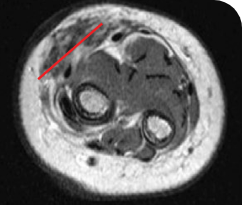 Post treatment scan for pediatric patient with infantile fibrosarcoma Post treatment tumor scan for a 5-year-old patient with infantile fibrosarcoma