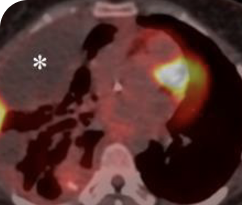 Initial diagnosis scan of 30-year-old female patient with bone metastases