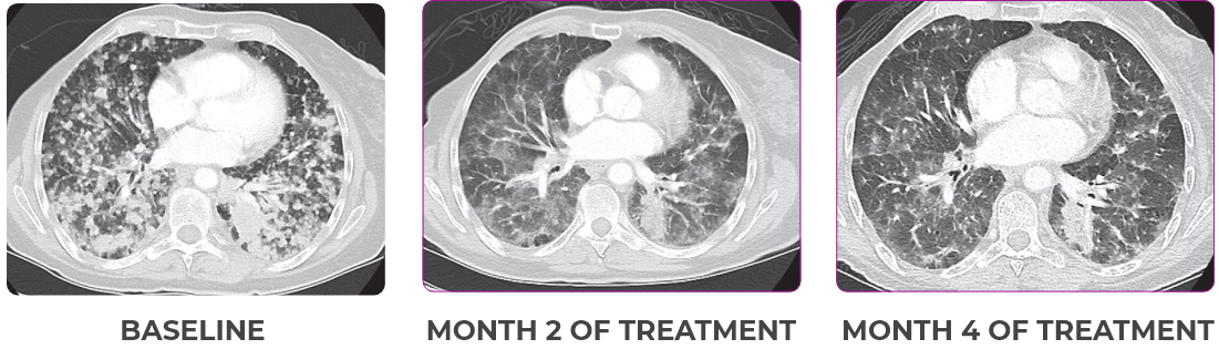 Lung metastases scan showing primary and metastatic lesions in a 76-year-old female patient