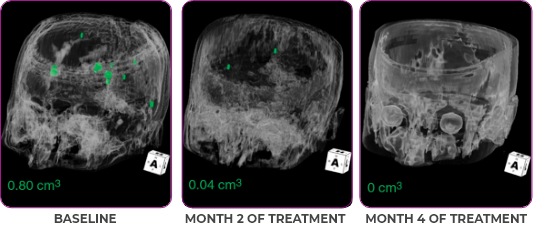 Brain metastases scan showing measurements in green for primary and metastatic lesions in a 76-year-old female patient.