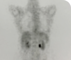 Post treatment body scan for a 56-year-old female patient with thyroid cancer who has multiple metastases.