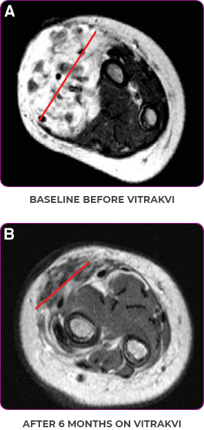 Tumor scan showing reduction in tumor in a 5-month-old with infantile fibrosarcoma