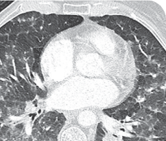Post treatment scan of 76-year-old female patient with brain metastases
