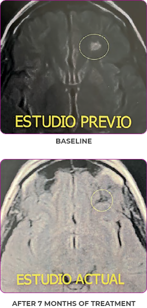 Female thyroid cancer patient brain scan before and after study