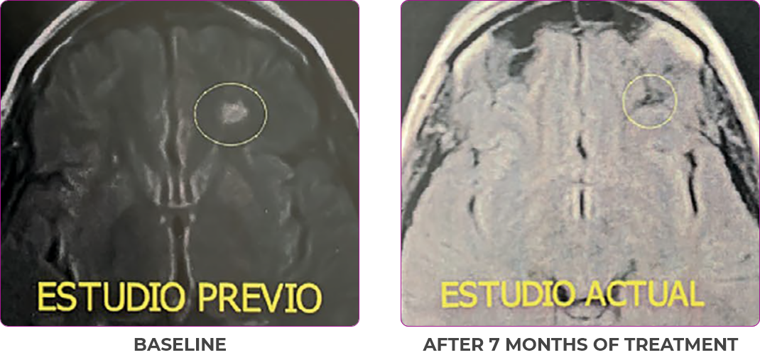 Female thyroid cancer patient brain scan before and after study