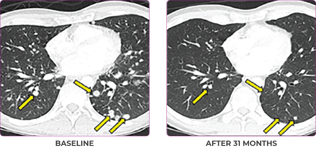Scan 2 of primary and metastatic lesions from a Metastatic disease for a 30-year-old male patient