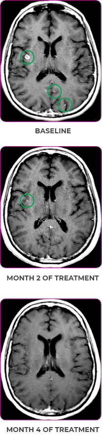 Brain scan in primary and metastatic lesions for a 76-year-old female patient