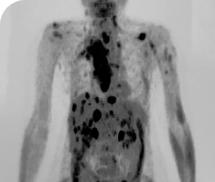 Baseline body scan for a 56-year-old female patient with thyroid cancer who has multiple metastases.
