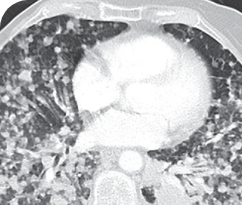 Baseline scan of 76-year-old female patient with brain metastases
