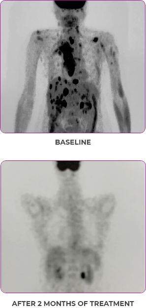 Body scan 2 showing primary and metastatic lesions at baseline and after 2 months of treatment in metastatic papillary thyroid cancer.