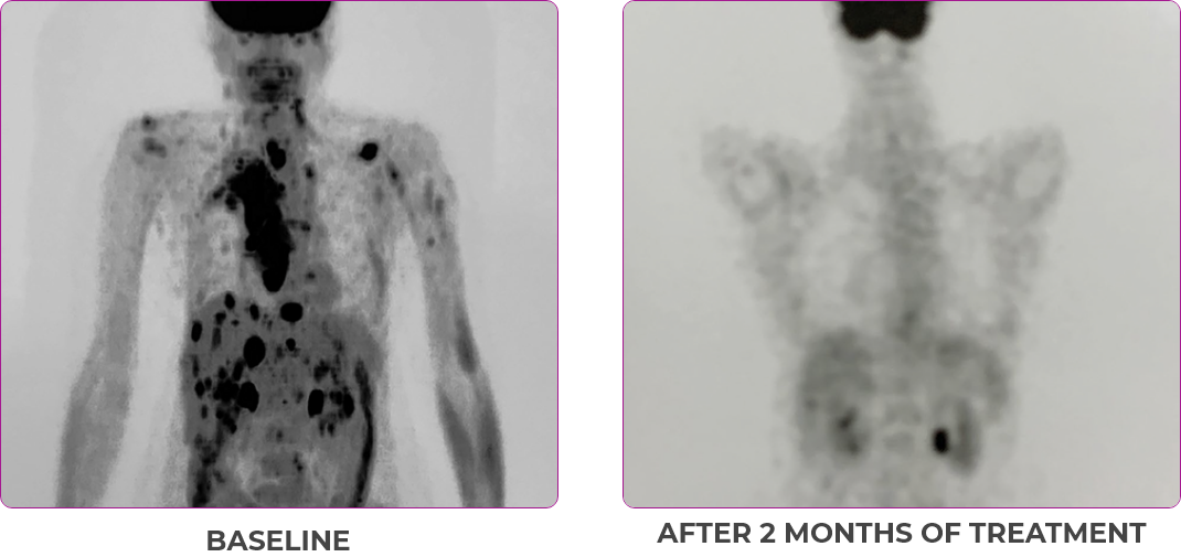 Body scan 2 showing primary and metastatic lesions at baseline and after 2 months of treatment in metastatic papillary thyroid cancer.