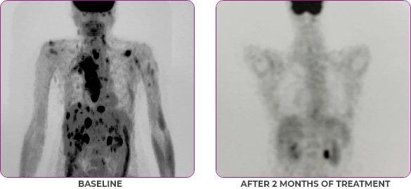 Body scan 2 showing primary and metastatic lesions at baseline and after 2 months of treatment in metastatic papillary thyroid cancer.