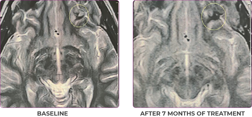 Brain scan 3 showing primary and metastatic lesions at baseline and after 7 months of treatment in metastatic papillary thyroid cancer