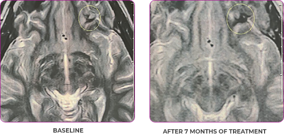 Brain scan 3 showing primary and metastatic lesions at baseline and after 7 months of treatment in metastatic papillary thyroid cancer