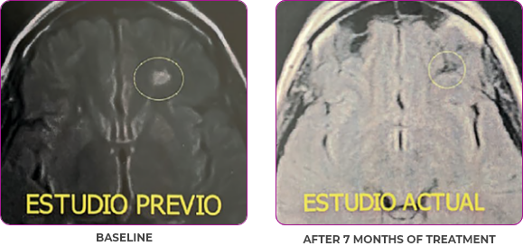 Brain scan 4 showing primary and metastatic lesions at baseline and after 7 months of treatment in metastatic papillary thyroid cancer
