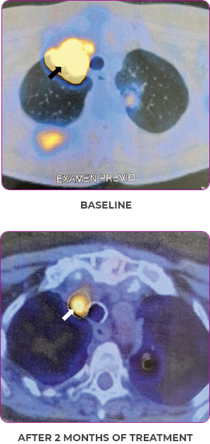 Scan 1 showing primary and metastatic lesions at baseline and after 2 months of treatment in metastatic papillary thyroid cancer.