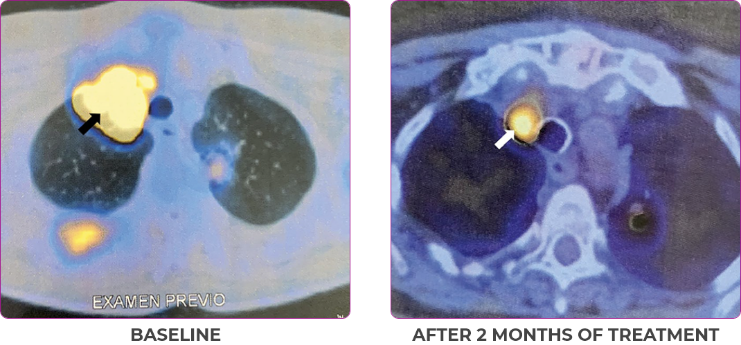 Scan 1 showing primary and metastatic lesions at baseline and after 2 months of treatment in metastatic papillary thyroid cancer.