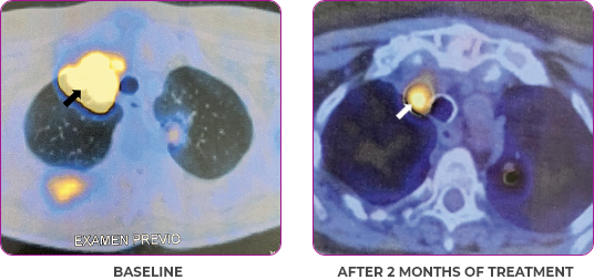 Scan 1 showing primary and metastatic lesions at baseline and after 2 months of treatment in metastatic papillary thyroid cancer.