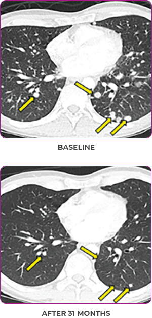 Lung scan 2 showing primary and metastatic lesions at baseline and after 31 months in metastatic papillary thyroid cancer