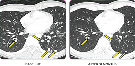 Lung scan 2 showing primary and metastatic lesions at baseline and after 31 months in metastatic papillary thyroid cancer