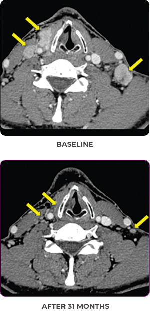 Thyroid scan 1 showing primary and metastatic lesions at baseline and after 31 months in metastatic papillary thyroid cancer