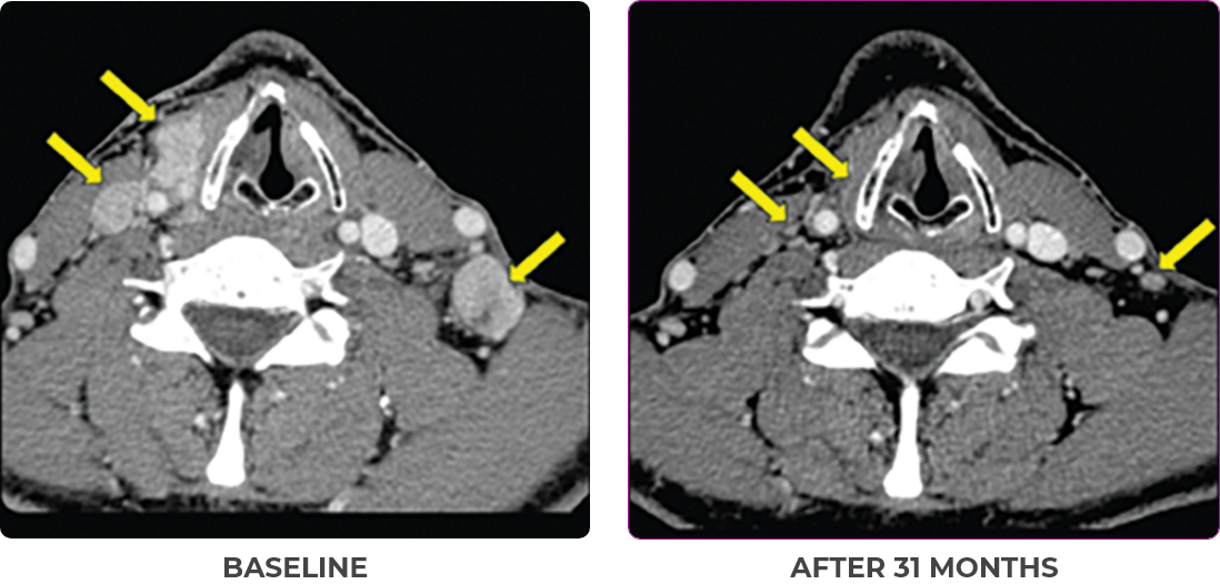 Thyroid scan 1 showing primary and metastatic lesions at baseline and after 31 months in metastatic papillary thyroid cancer