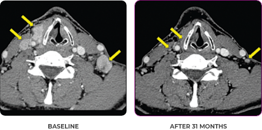 Thyroid scan 1 showing primary and metastatic lesions at baseline and after 31 months in metastatic papillary thyroid cancer