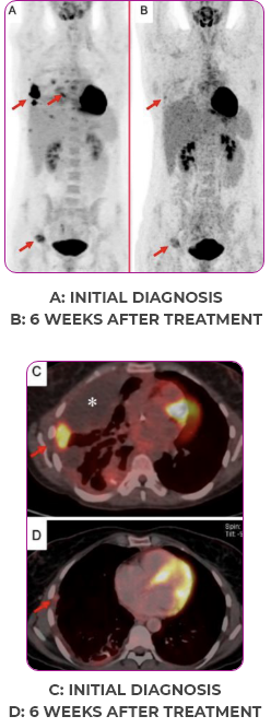 Lung and bone scan 2 showing primary and metastatic lesions at initial diagnosis and 6 weeks after treatment