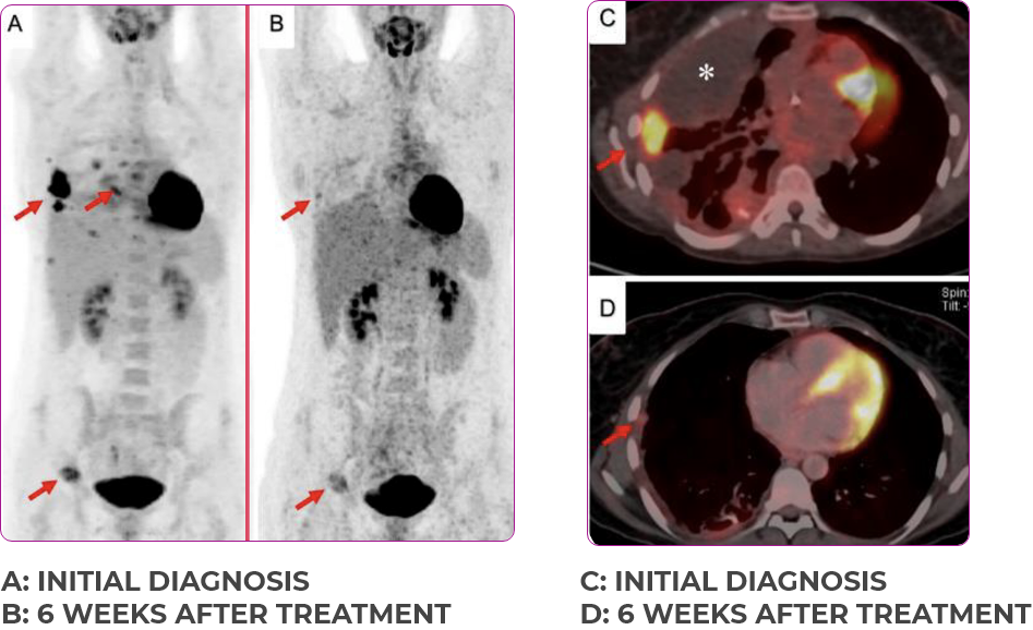 Lung and bone scan 2 showing primary and metastatic lesions at initial diagnosis and 6 weeks after treatment