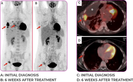 Lung and bone scan 2 showing primary and metastatic lesions at initial diagnosis and 6 weeks after treatment