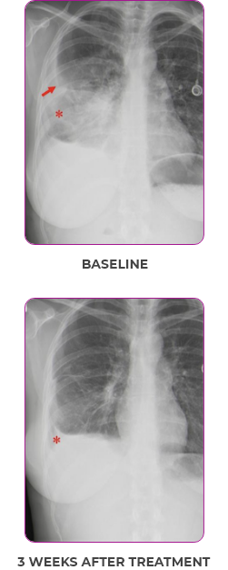 Lung scan 1 showing primary and metastatic lesions at baseline and 3 weeks after treatment in a 30-year-old female patient with metastatic NSCLC