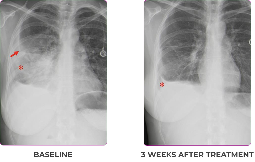 Lung scan 1 showing primary and metastatic lesions at baseline and 3 weeks after treatment in a 30-year-old female patient with metastatic NSCLC