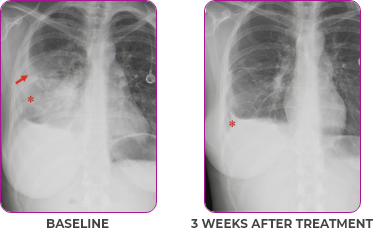 Lung scan 1 showing primary and metastatic lesions at baseline and 3 weeks after treatment in a 30-year-old female patient with metastatic NSCLC