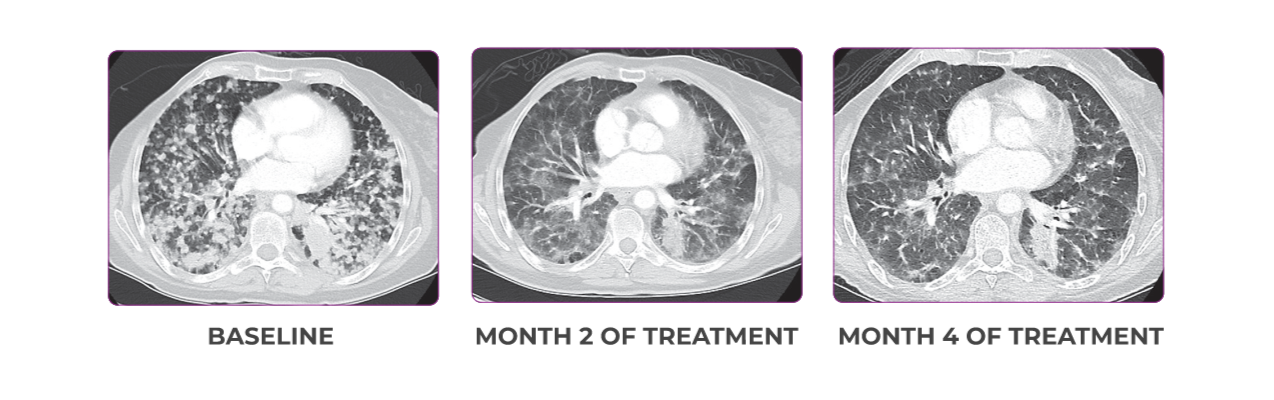 Lung metastases scan showing primary and metastatic lesions at baseline, month 2 of treatment, and month 4 of treatment