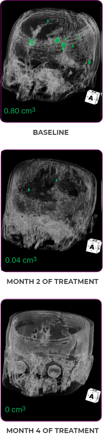 Brain scan 3 showing primary and metastatic lesions at baseline, month 2 of treatment, and month 4 of treatment