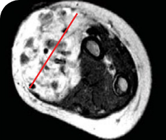 Baseline tumor scan for a 5-year-old patient with infantile fibrosarcoma.